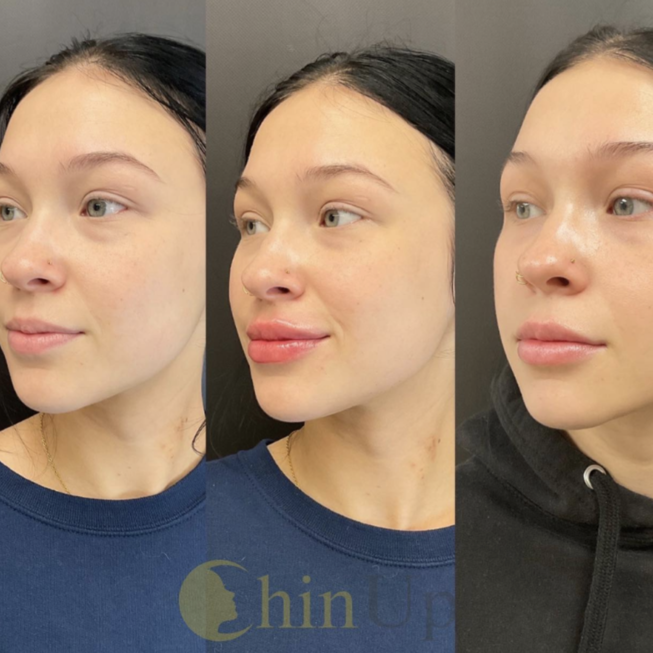 three side by side portraits of a woman showing her face before and after a cosmetic procedure, highlighting changes in her lips and chin. she has light skin, blue eyes, and dark hair pulled back. the words "chin up" appear at the bottom. medspa near me